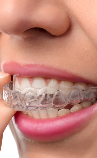 Invisalign 