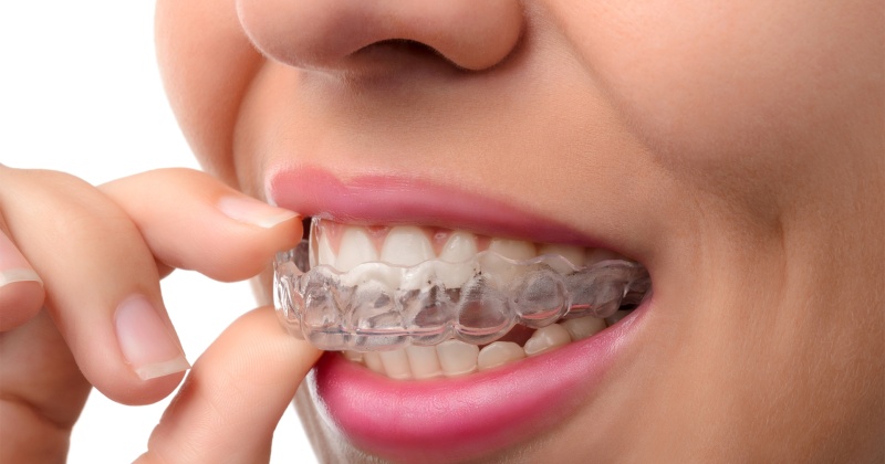 Invisalign 